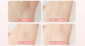 Before and after- Urboo IPL Hair Removal